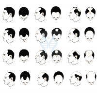 【佳學(xué)基因檢測(cè)】過(guò)早<font color='red'>脫發(fā)</font>、掉發(fā)太多怎么辦？你的方法可能是錯(cuò)的！