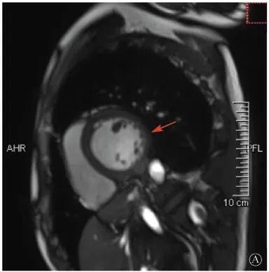 協和疑難︱第67例：臨床表現胸痛伴肌酸激酶升高