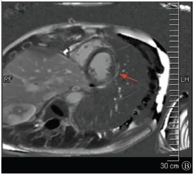 協和疑難︱第67例：臨床表現胸痛伴肌酸激酶升高