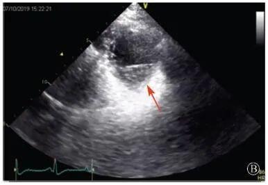 協和疑難︱第67例：臨床表現胸痛伴肌酸激酶升高