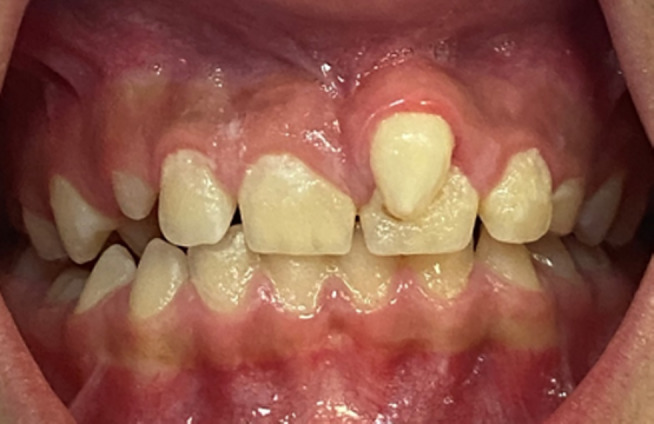 牙齒基因異?；驒z測