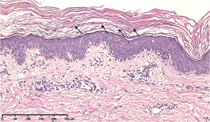 變異性紅斑角化癥佳學(xué)基因強(qiáng)