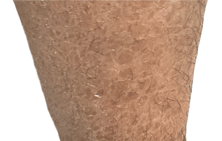 圖1：圖1. 下肢出現(xiàn)多邊形、暗色、鱗狀斑塊伴增厚斑塊。