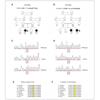 【佳學(xué)基因檢測(cè)】<font color='red'><font color='red'>精神分裂</font></font>癥患者找到致病基因：案例分享