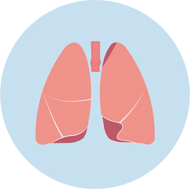 <b>【佳學基因檢測】非小細胞肺癌靶向治療藥物泰圣奇基因檢測</b>